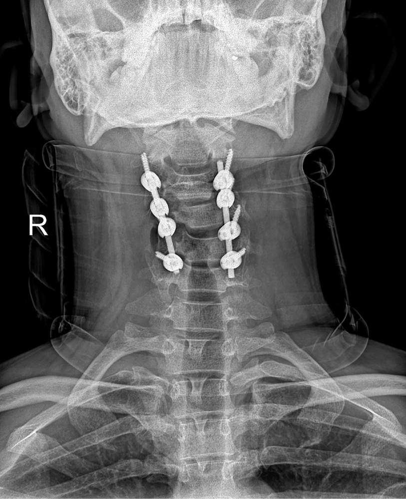 C2 FracturesHangman's Fracture After a Car Accident in San Diego