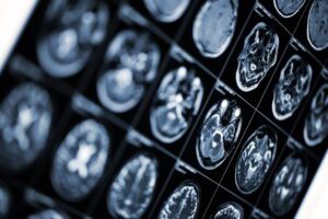 Brain Injury
